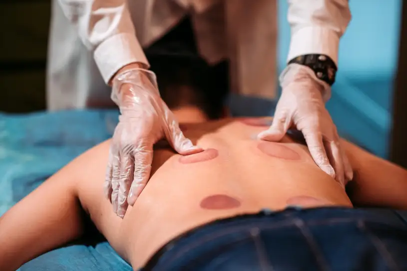 afbeelding van het einde van een cupping massage