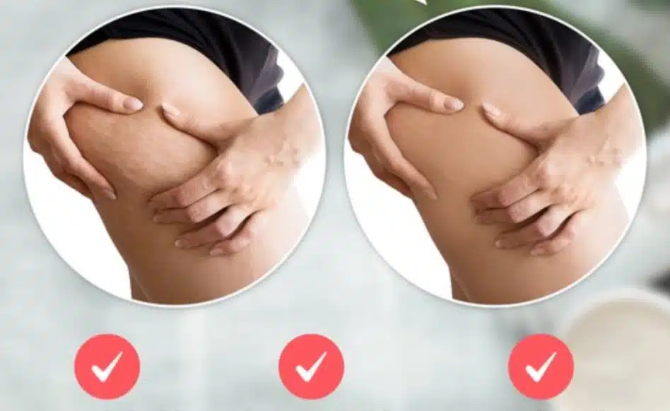 cellulite behandelen